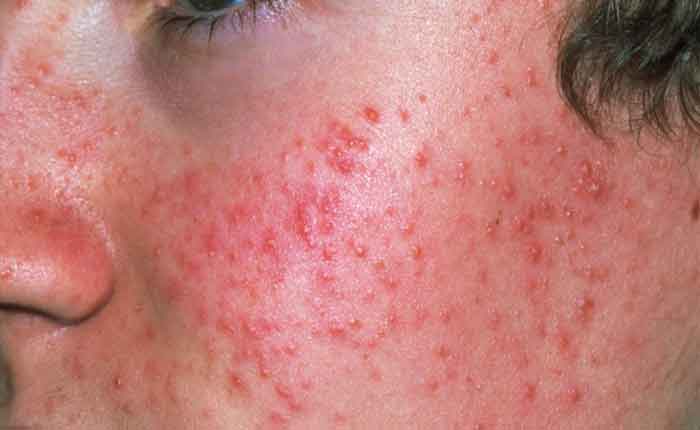 Acne e condições da pele